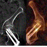 L’examen par SPECT/CT – un précieux complément à la scintigraphie osseuse classique